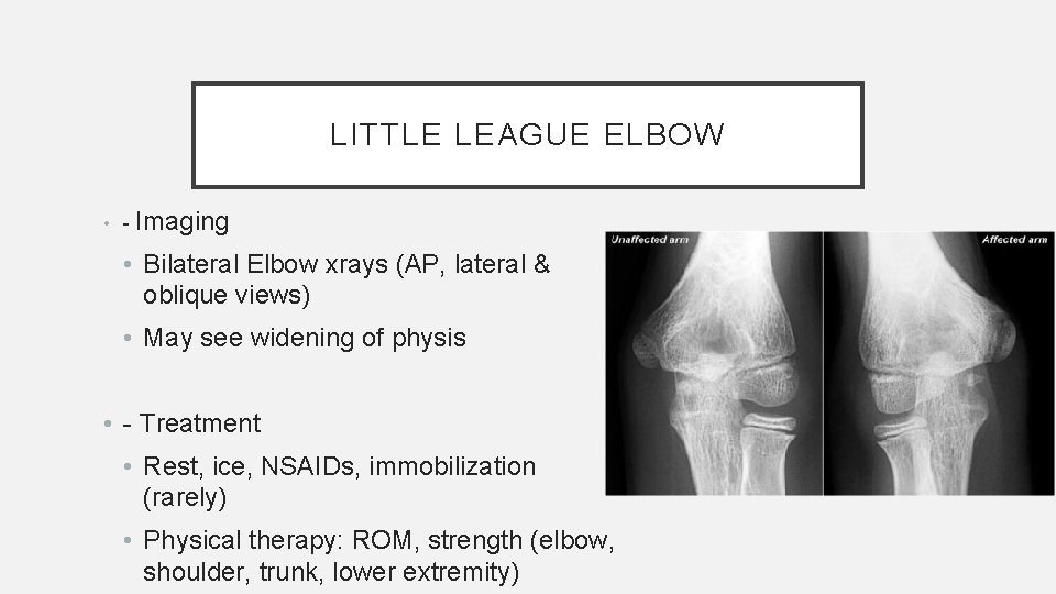 LITTLE LEAGUE ELBOW • - Imaging • Bilateral Elbow xrays (AP, lateral & oblique