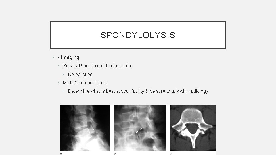 SPONDYLOLYSIS • - Imaging • Xrays AP and lateral lumbar spine • No obliques