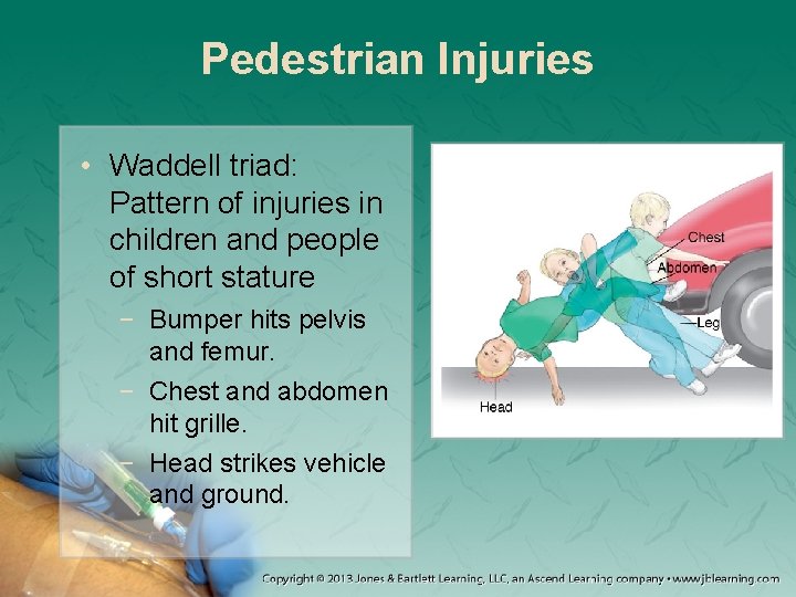 Pedestrian Injuries • Waddell triad: Pattern of injuries in children and people of short