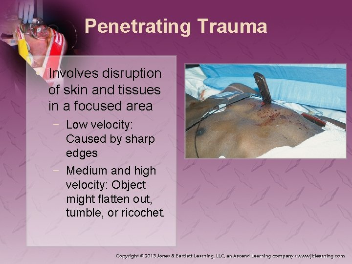 Penetrating Trauma • Involves disruption of skin and tissues in a focused area −