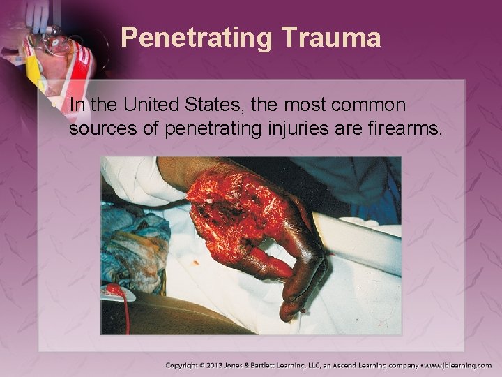 Penetrating Trauma • In the United States, the most common sources of penetrating injuries