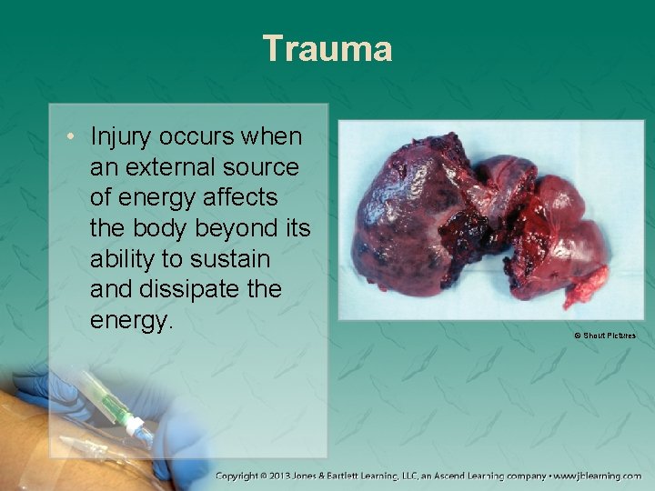 Trauma • Injury occurs when an external source of energy affects the body beyond