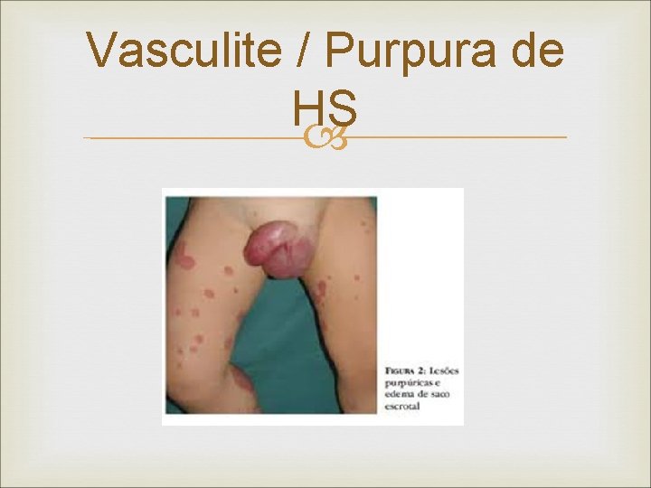 Vasculite / Purpura de HS 