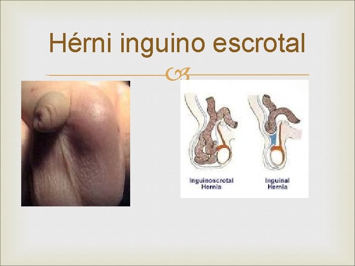 Hérni inguino escrotal 