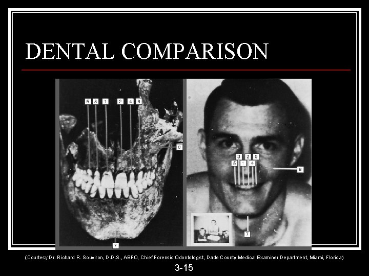 DENTAL COMPARISON (Courtesy Dr. Richard R. Souviron, D. D. S. , ABFO, Chief Forensic