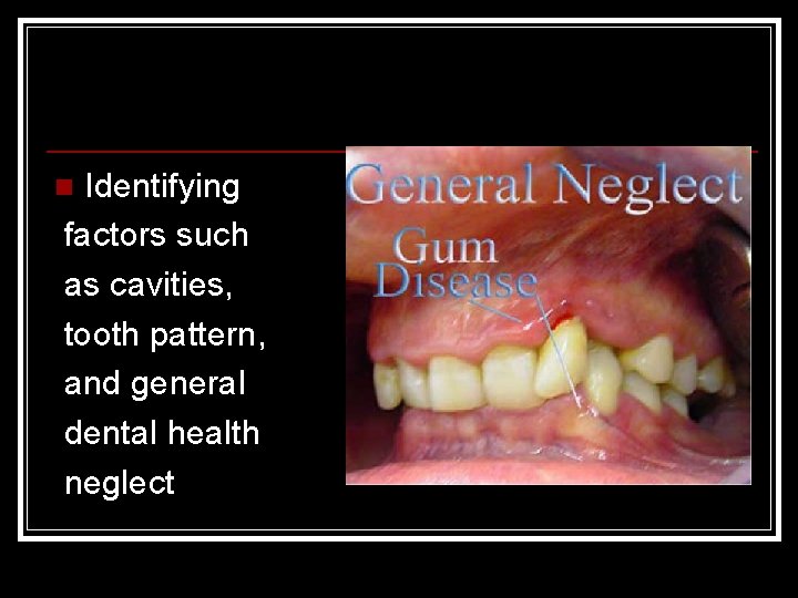 Identifying factors such as cavities, tooth pattern, and general dental health neglect n 