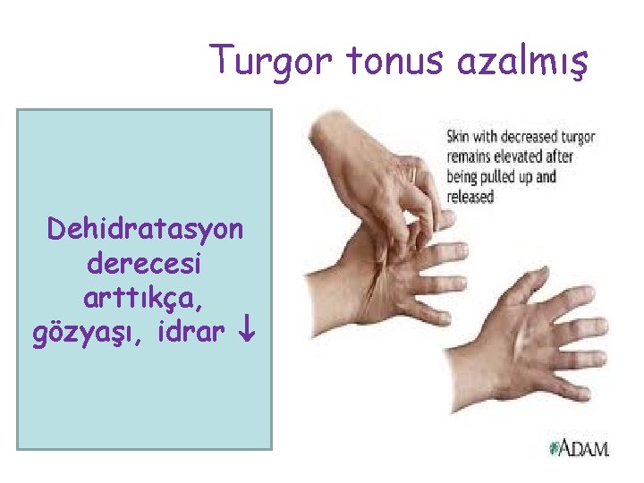 Turgor tonus azalmış • Dehidratasyon derecesi arttıkça, gözyaşı, idrar 