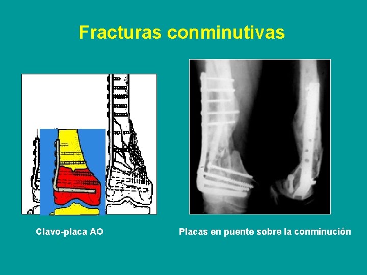 Fracturas conminutivas Clavo-placa AO Placas en puente sobre la conminución 