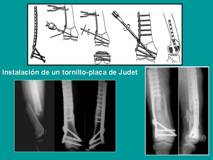 Instalación de un tornillo-placa de Judet 