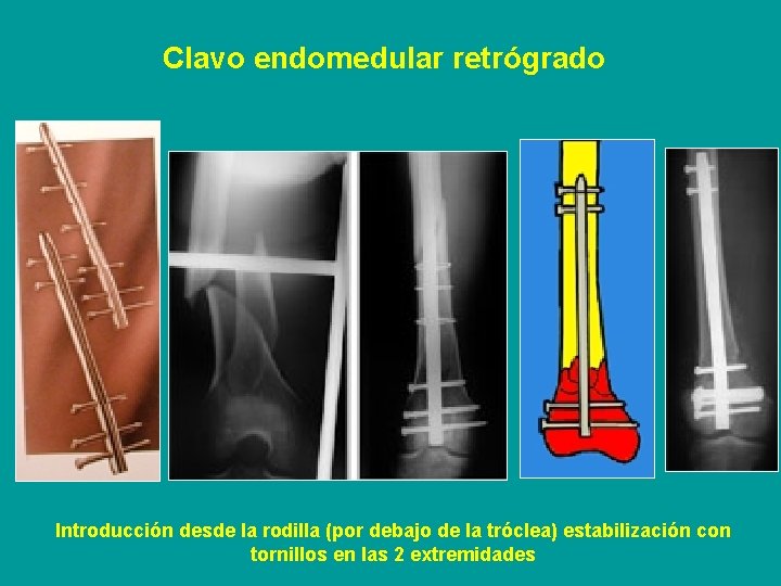 Clavo endomedular retrógrado Introducción desde la rodilla (por debajo de la tróclea) estabilización con