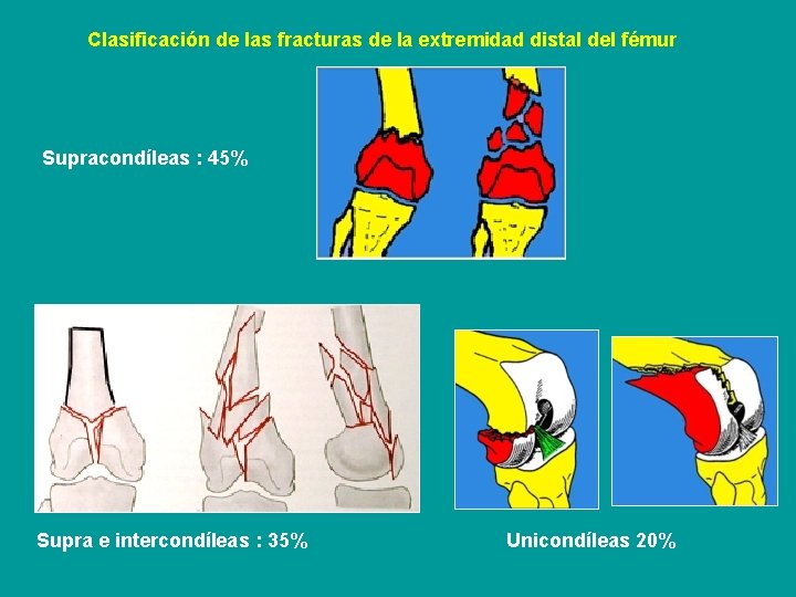 Clasificación de las fracturas de la extremidad distal del fémur Supracondíleas : 45% Supra