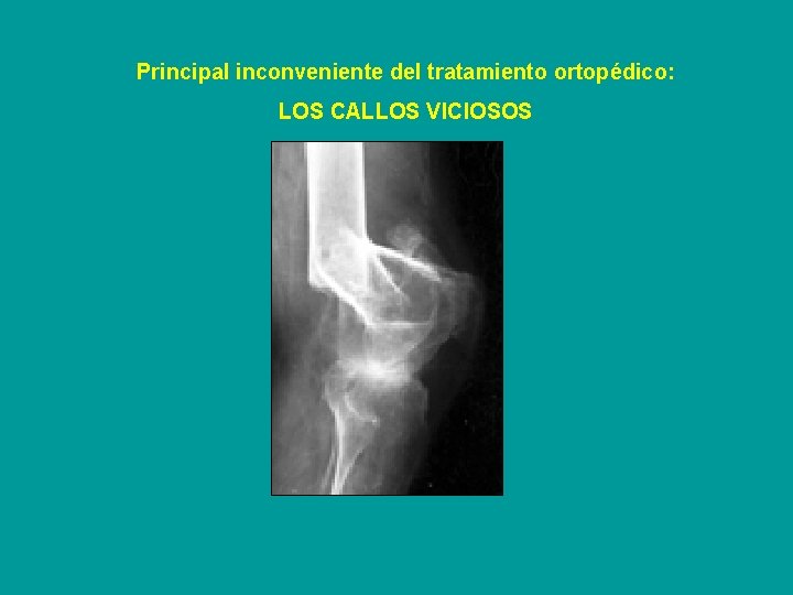 Principal inconveniente del tratamiento ortopédico: LOS CALLOS VICIOSOS 
