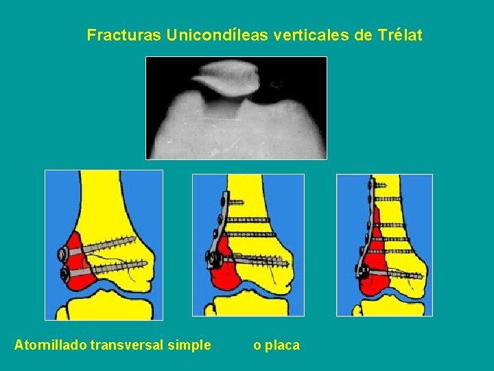 Fracturas Unicondíleas verticales de Trélat Atornillado transversal simple o placa 