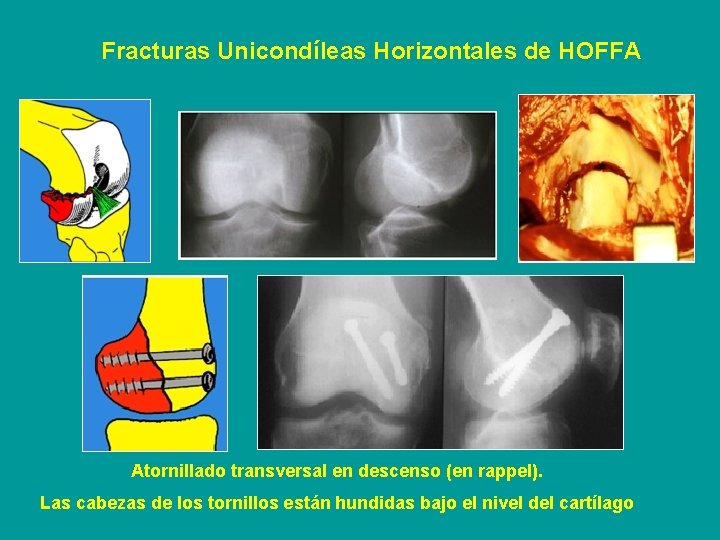 Fracturas Unicondíleas Horizontales de HOFFA Atornillado transversal en descenso (en rappel). Las cabezas de