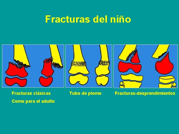 Fracturas del niño Fracturas clásicas Como para el adulto Tubo de plomo Fracturas-desprendimientos 