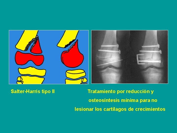 Salter-Harris tipo II Tratamiento por reducción y osteosíntesis mínima para no lesionar los cartílagos