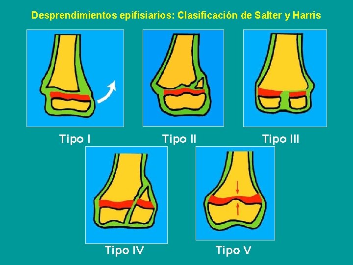 Desprendimientos epifisiarios: Clasificación de Salter y Harris Tipo II Tipo IV Tipo III Tipo