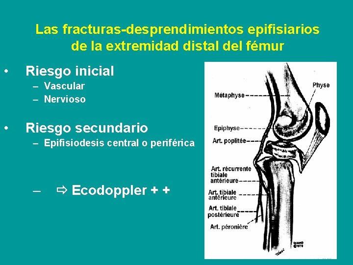 Las fracturas-desprendimientos epifisiarios de la extremidad distal del fémur • Riesgo inicial – Vascular