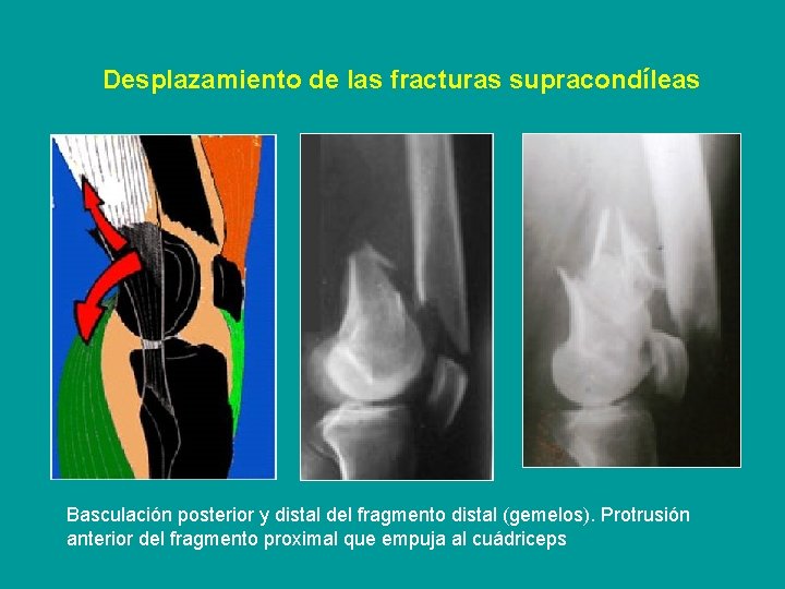 Desplazamiento de las fracturas supracondíleas Basculación posterior y distal del fragmento distal (gemelos). Protrusión