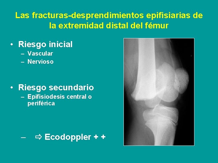 Las fracturas-desprendimientos epifisiarias de la extremidad distal del fémur • Riesgo inicial – Vascular