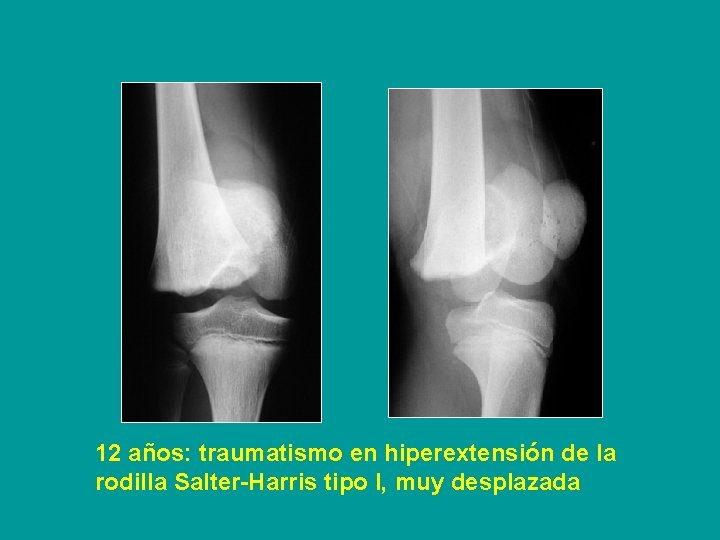 12 años: traumatismo en hiperextensión de la rodilla Salter-Harris tipo I, muy desplazada 