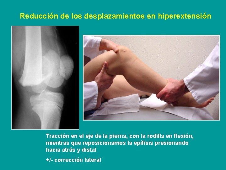 Reducción de los desplazamientos en hiperextensión Tracción en el eje de la pierna, con