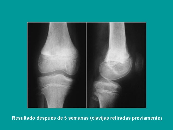 Resultado después de 5 semanas (clavijas retiradas previamente) 