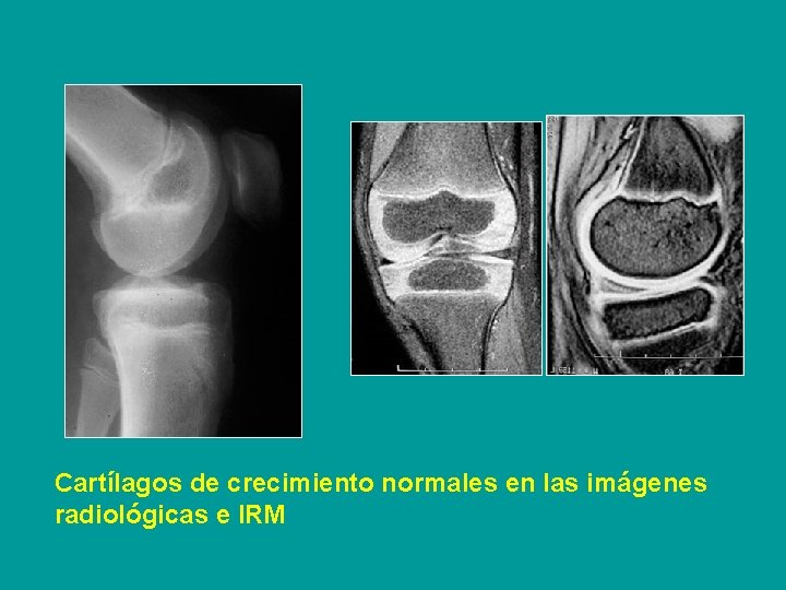 Cartílagos de crecimiento normales en las imágenes radiológicas e IRM 