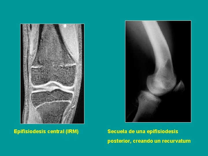 Epifisiodesis central (IRM) Secuela de una epifisiodesis posterior, creando un recurvatum 