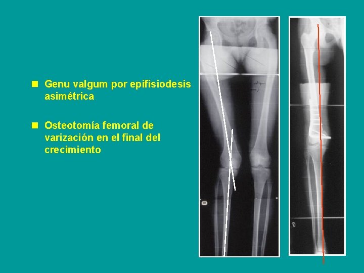 n Genu valgum por epifisiodesis asimétrica n Osteotomía femoral de varización en el final