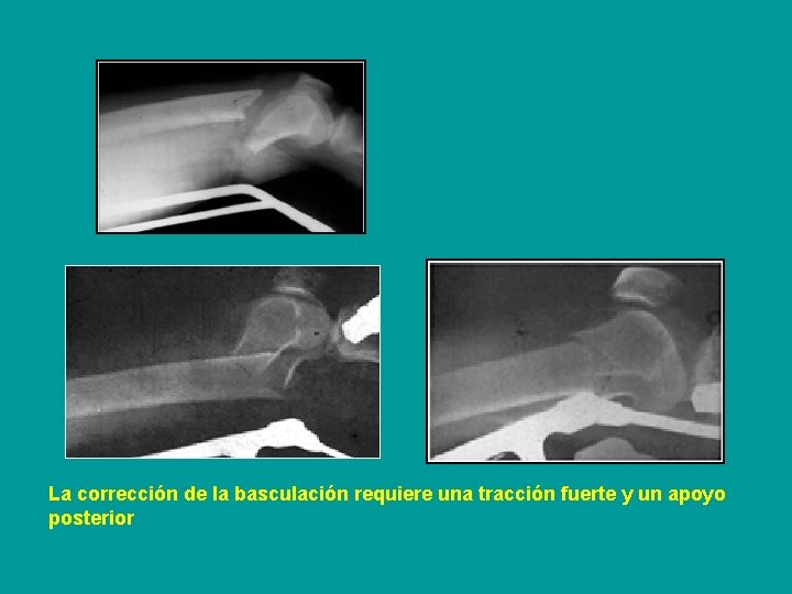 La corrección de la basculación requiere una tracción fuerte y un apoyo posterior 