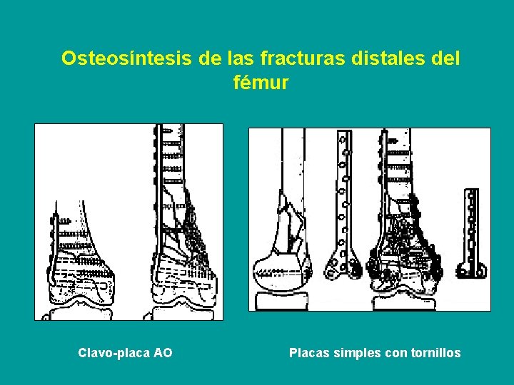 Osteosíntesis de las fracturas distales del fémur Clavo-placa AO Placas simples con tornillos 