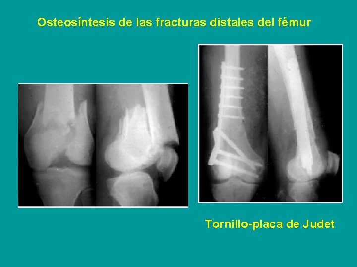 Osteosíntesis de las fracturas distales del fémur Tornillo-placa de Judet 