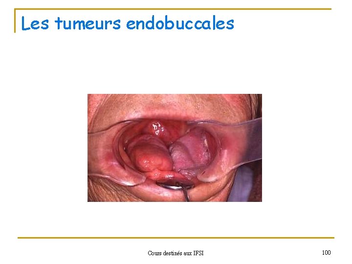 Les tumeurs endobuccales Cours destinés aux IFSI 100 