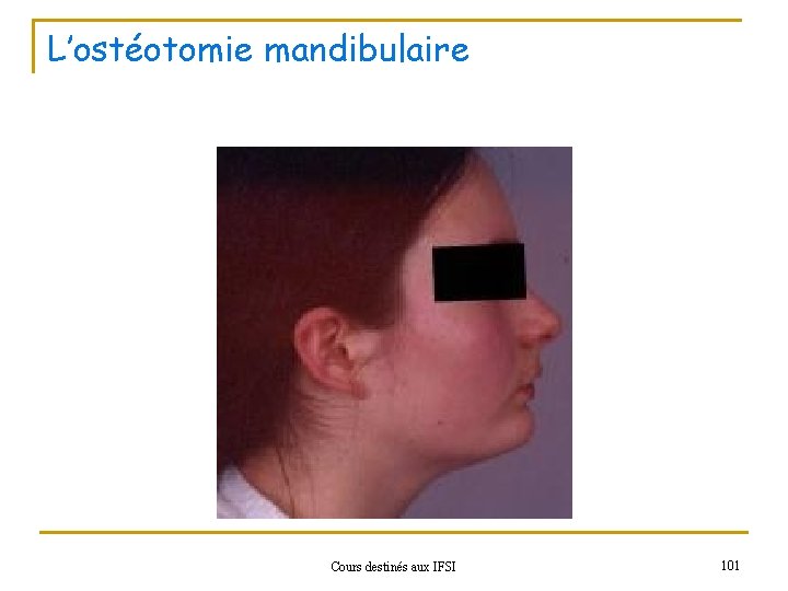L’ostéotomie mandibulaire Cours destinés aux IFSI 101 