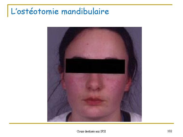 L’ostéotomie mandibulaire Cours destinés aux IFSI 102 