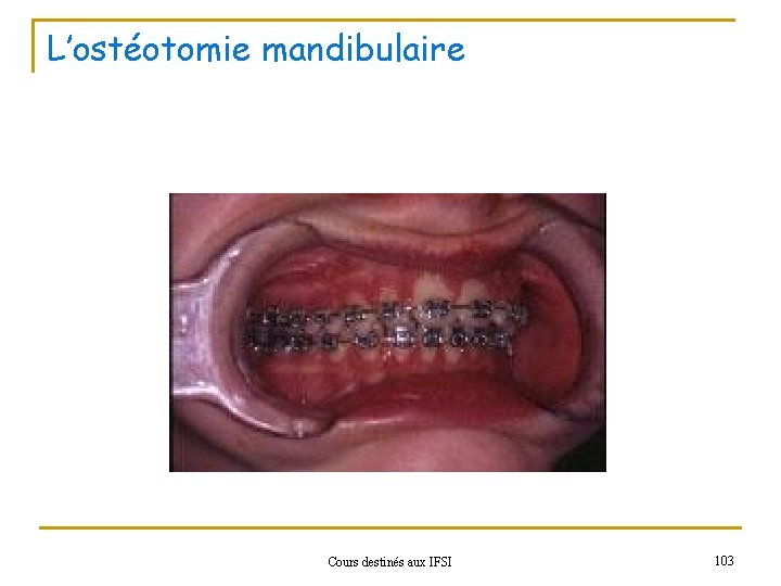 L’ostéotomie mandibulaire Cours destinés aux IFSI 103 