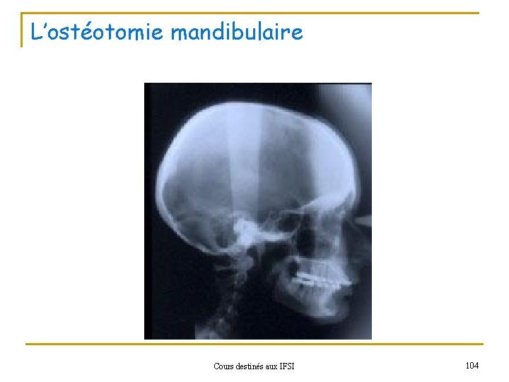L’ostéotomie mandibulaire Cours destinés aux IFSI 104 