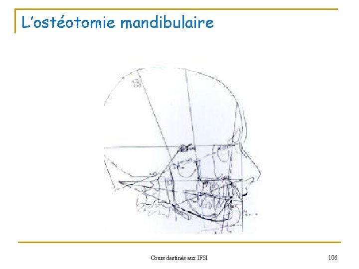 L’ostéotomie mandibulaire Cours destinés aux IFSI 106 