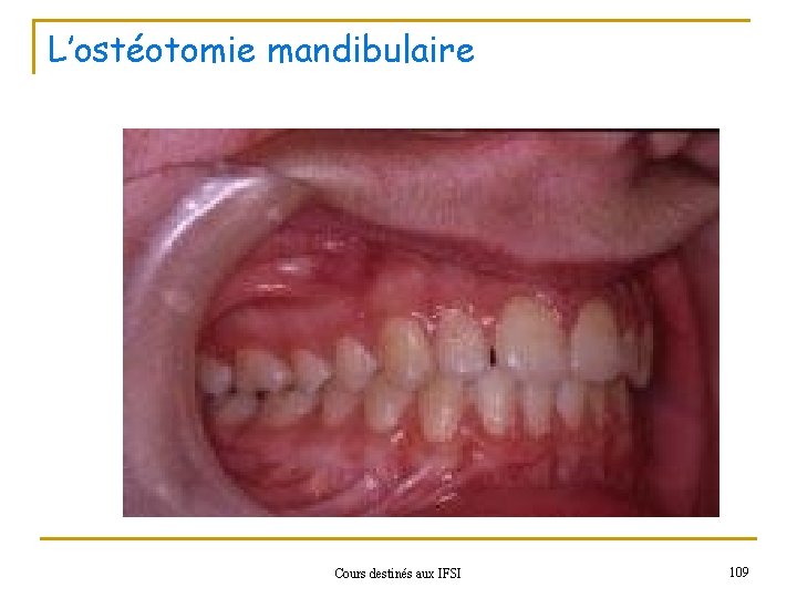 L’ostéotomie mandibulaire Cours destinés aux IFSI 109 