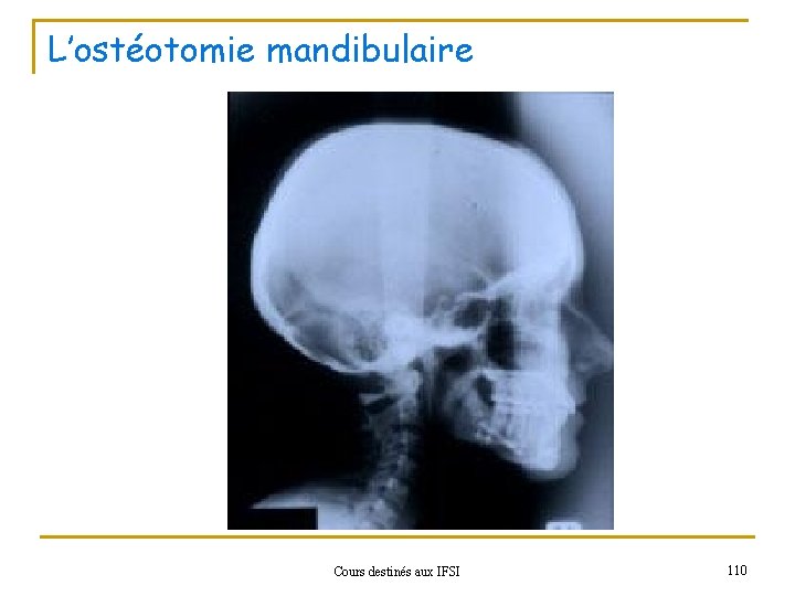 L’ostéotomie mandibulaire Cours destinés aux IFSI 110 