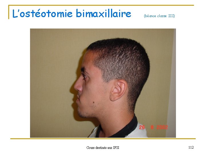L’ostéotomie bimaxillaire Cours destinés aux IFSI (béance classe III) 112 