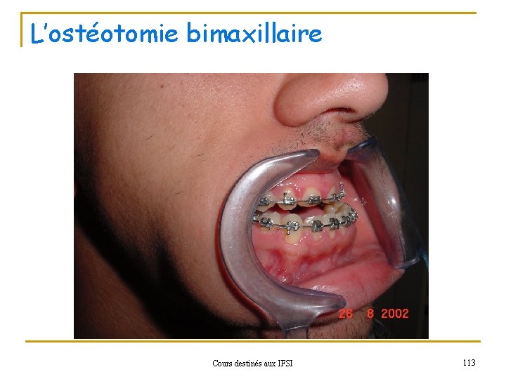 L’ostéotomie bimaxillaire Cours destinés aux IFSI 113 