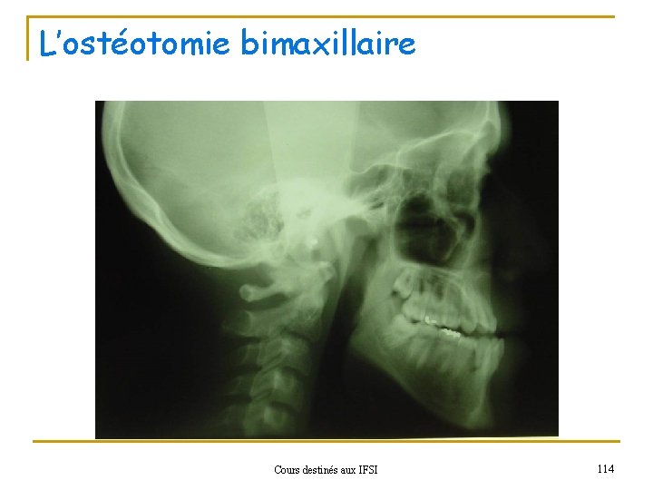 L’ostéotomie bimaxillaire Cours destinés aux IFSI 114 