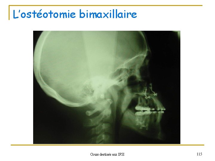 L’ostéotomie bimaxillaire Cours destinés aux IFSI 115 