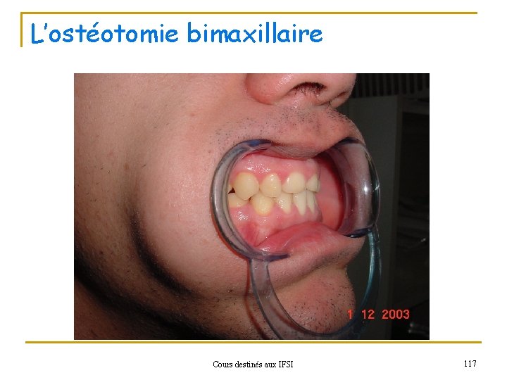 L’ostéotomie bimaxillaire Cours destinés aux IFSI 117 