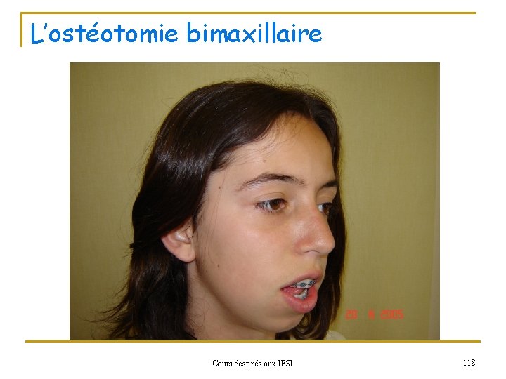 L’ostéotomie bimaxillaire Cours destinés aux IFSI 118 