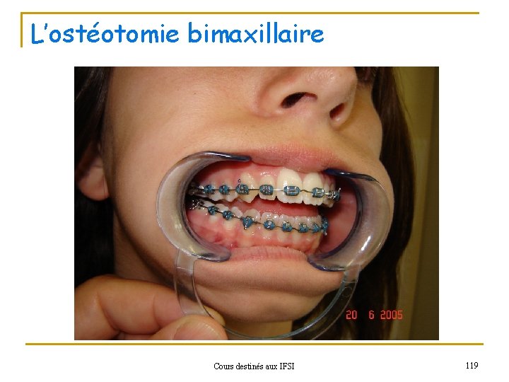 L’ostéotomie bimaxillaire Cours destinés aux IFSI 119 