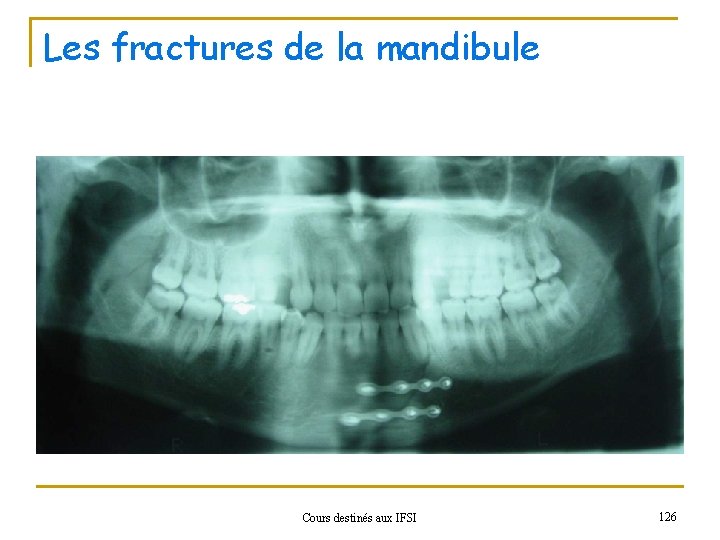 Les fractures de la mandibule Cours destinés aux IFSI 126 