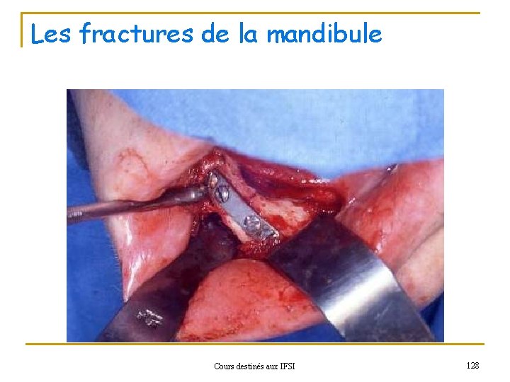 Les fractures de la mandibule Cours destinés aux IFSI 128 